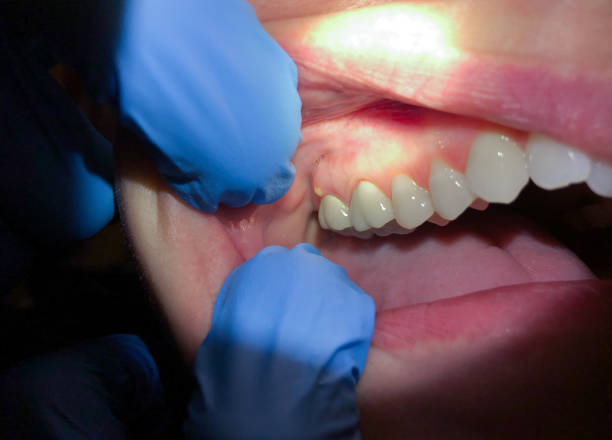 Best Emergency Cosmetic Dentistry (e.g., broken veneers) in New Castle Northwest, PA